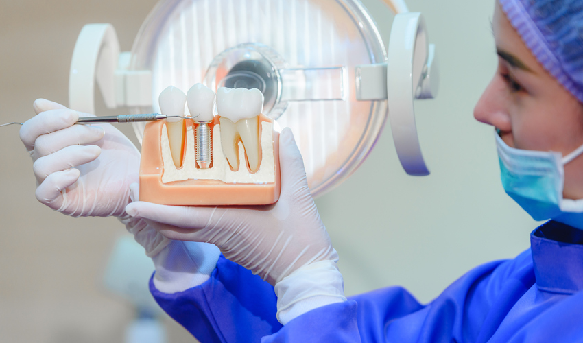 What Are Dental Implants?